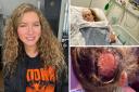 Bromley schoolgirl Coco Brown went to an American salon to look like Taylor Swift. But the chemicals started smoking in her hair and left her with a third degree burn