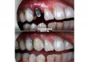 Dental implants in Turkey