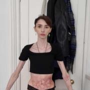 A 'massive foodie' claims she woke up one day to find she was unable to eat,  discovering she had stomach paralysis.